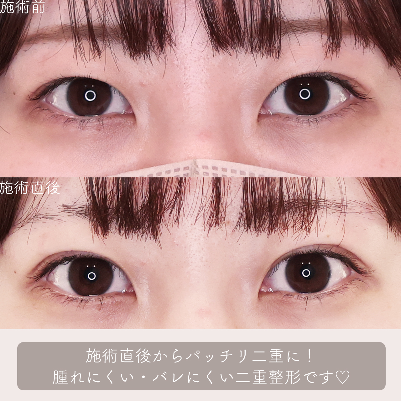 クイックコスメリングの症例写真 施術前後