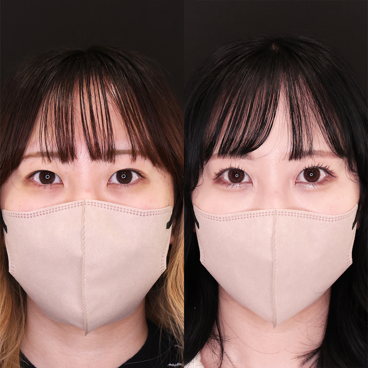 クイックコスメリングの症例写真 施術前後