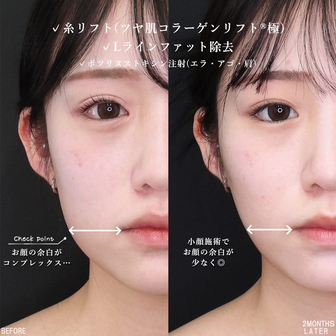 TAC式 ツヤ肌コラーゲンリフト®/Lラインファット除去（エラ下脂肪除去）/エラボトックス注射の症例写真 施術前後 