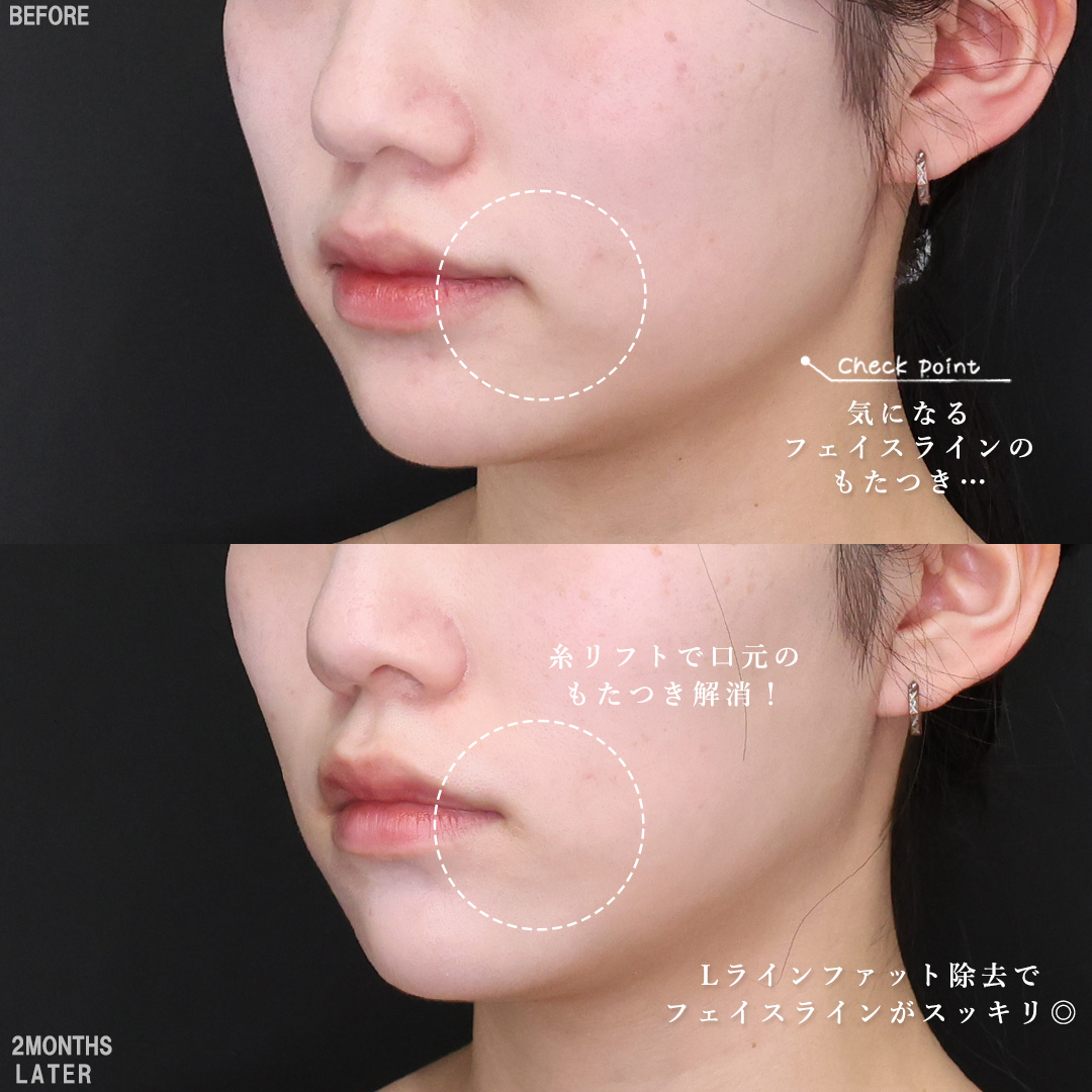 TAC式 ツヤ肌コラーゲンリフト®/Lラインファット除去（エラ下脂肪除去）/エラボトックス注射の症例写真 施術前後 