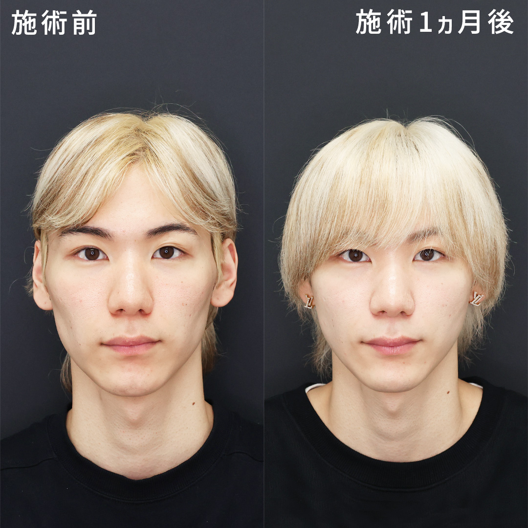 メンズの強すぎる頬コケを解消|ヒアルロン酸×糸リフト
