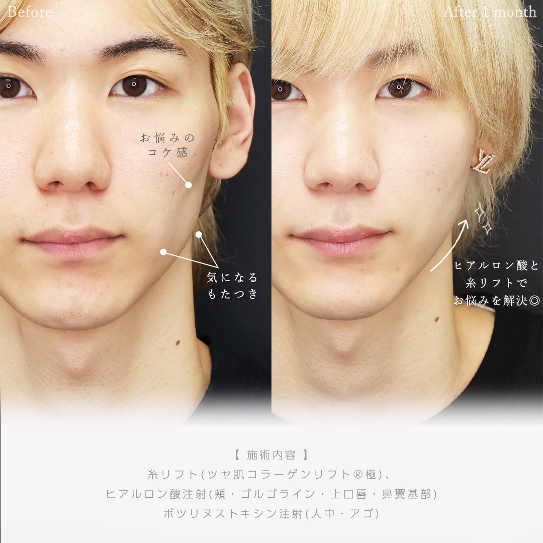 TAC式 ツヤ肌コラーゲンリフト®/ゴルゴ線のヒアルロン酸注射/顎のヒアルロン酸注射の症例写真 施術前後 
