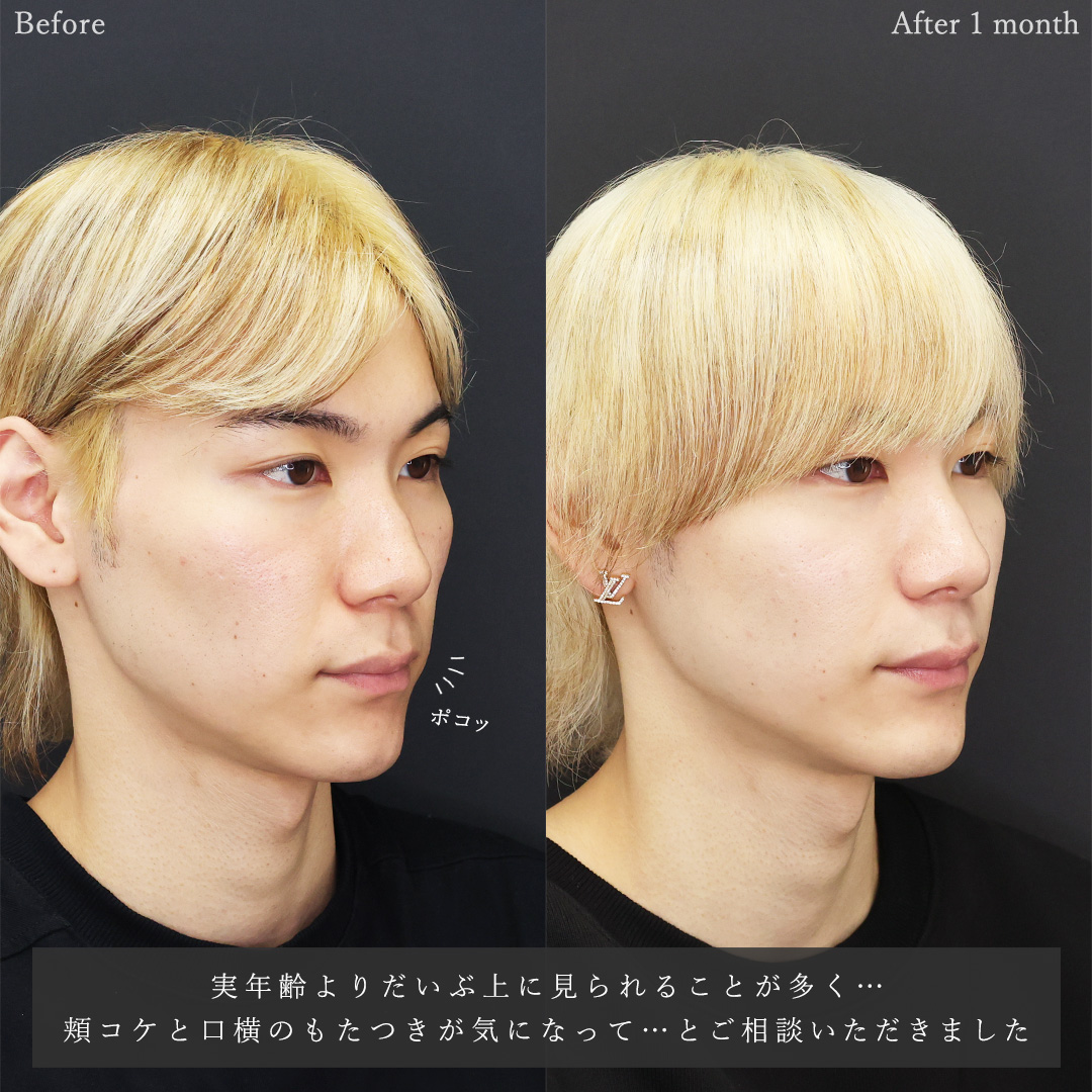 TAC式 ツヤ肌コラーゲンリフト®/ゴルゴ線のヒアルロン酸注射/顎のヒアルロン酸注射の症例写真 施術前後 