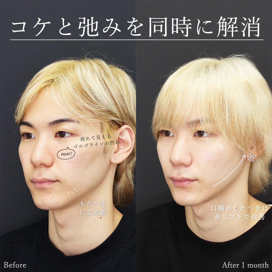 TAC式 ツヤ肌コラーゲンリフト®/ゴルゴ線のヒアルロン酸注射/顎のヒアルロン酸注射の症例写真 施術前後 