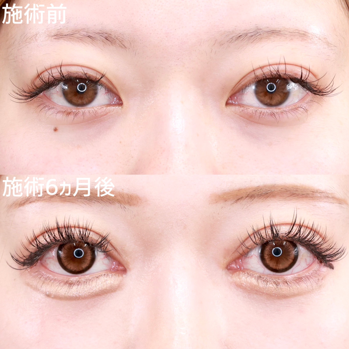 【タレ目形成&目頭切開術】惹きつけられる大きな目元に!