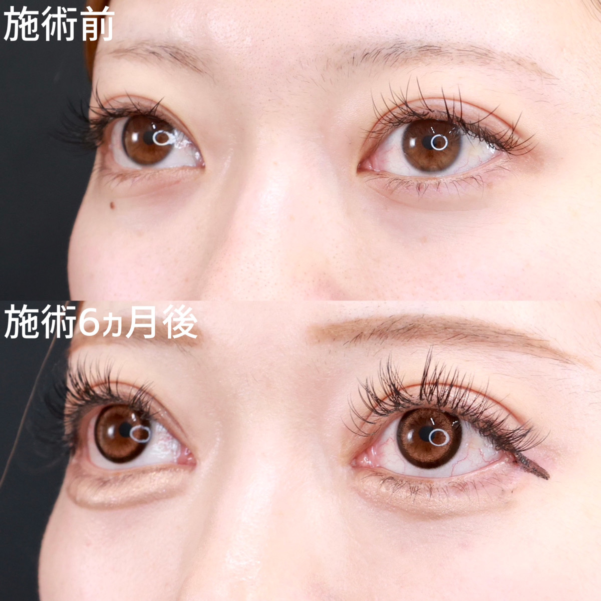 グラマラスライン(タレ目形成)/目尻切開術/目尻靭帯移動術の症例写真 施術前後