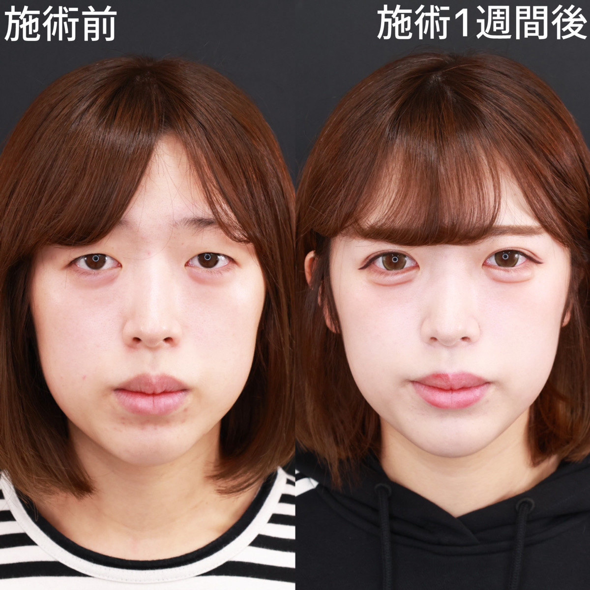 クイックコスメリング/涙袋形成(ヒアルロン酸注射)の症例写真 施術前後