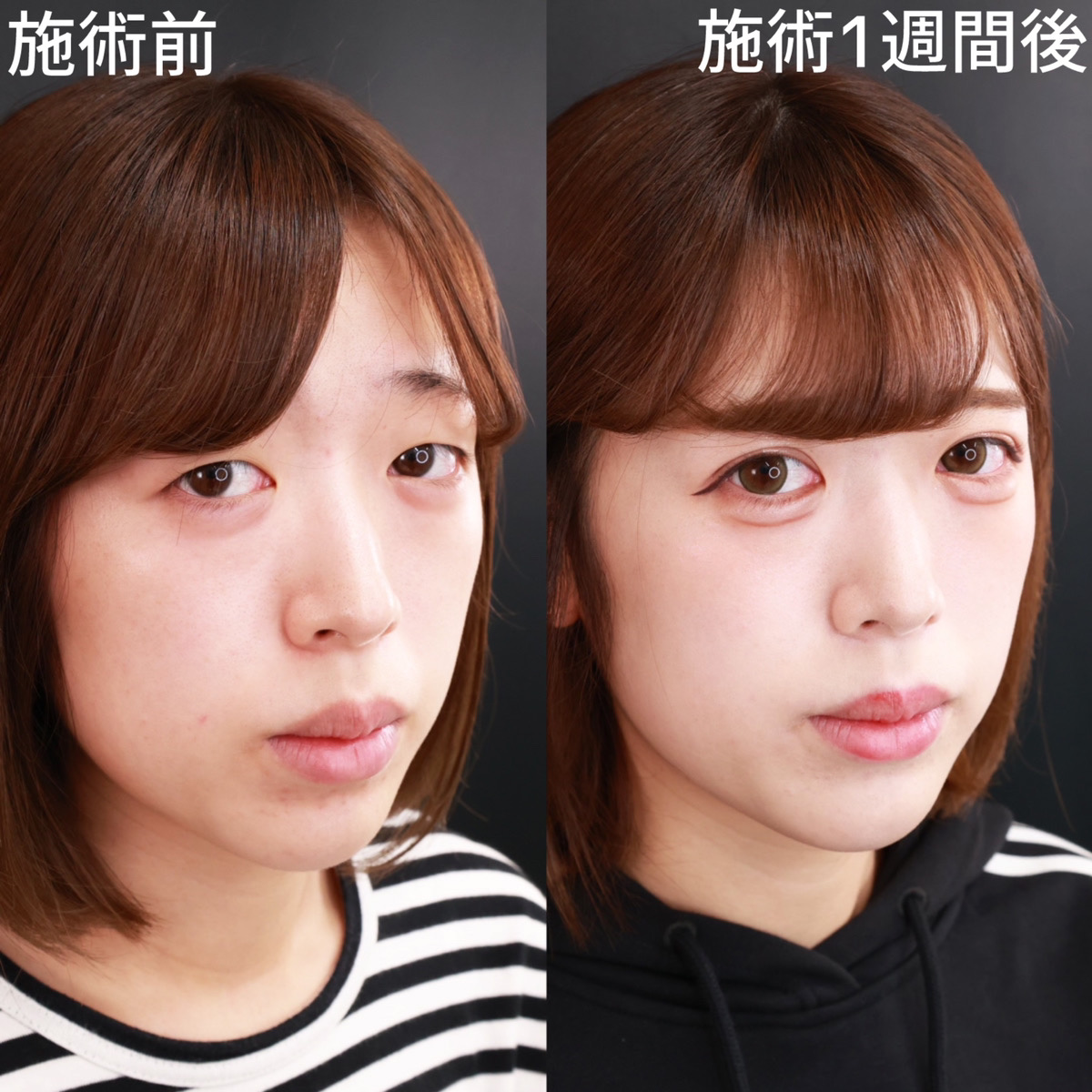 クイックコスメリング/涙袋形成(ヒアルロン酸注射)の症例写真 施術前後