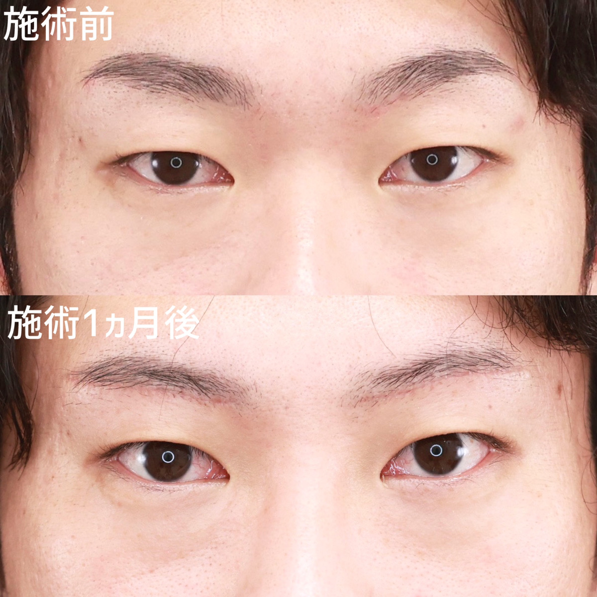 眉毛下切開術の症例写真 施術前後