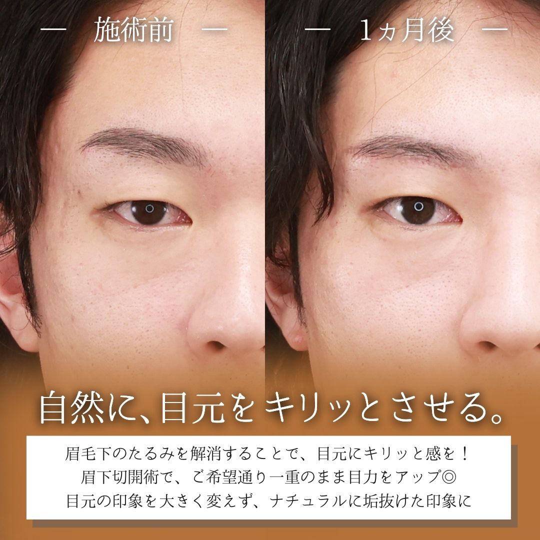 眉毛下切開術の症例写真 施術前後