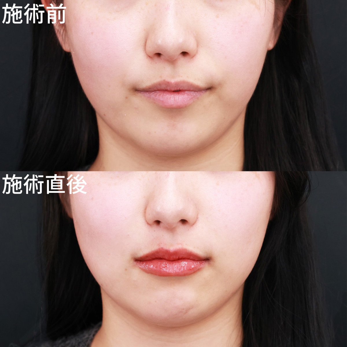 【唇ヒアルロン酸注射】ぽってりとした、あざと可愛い唇に！