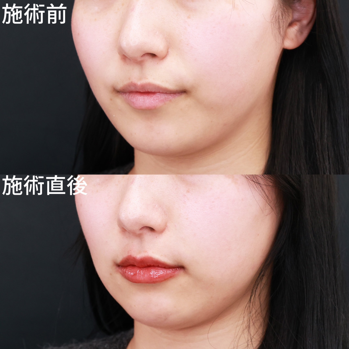 ヒアルロン酸注射:その他の症例写真 施術前後