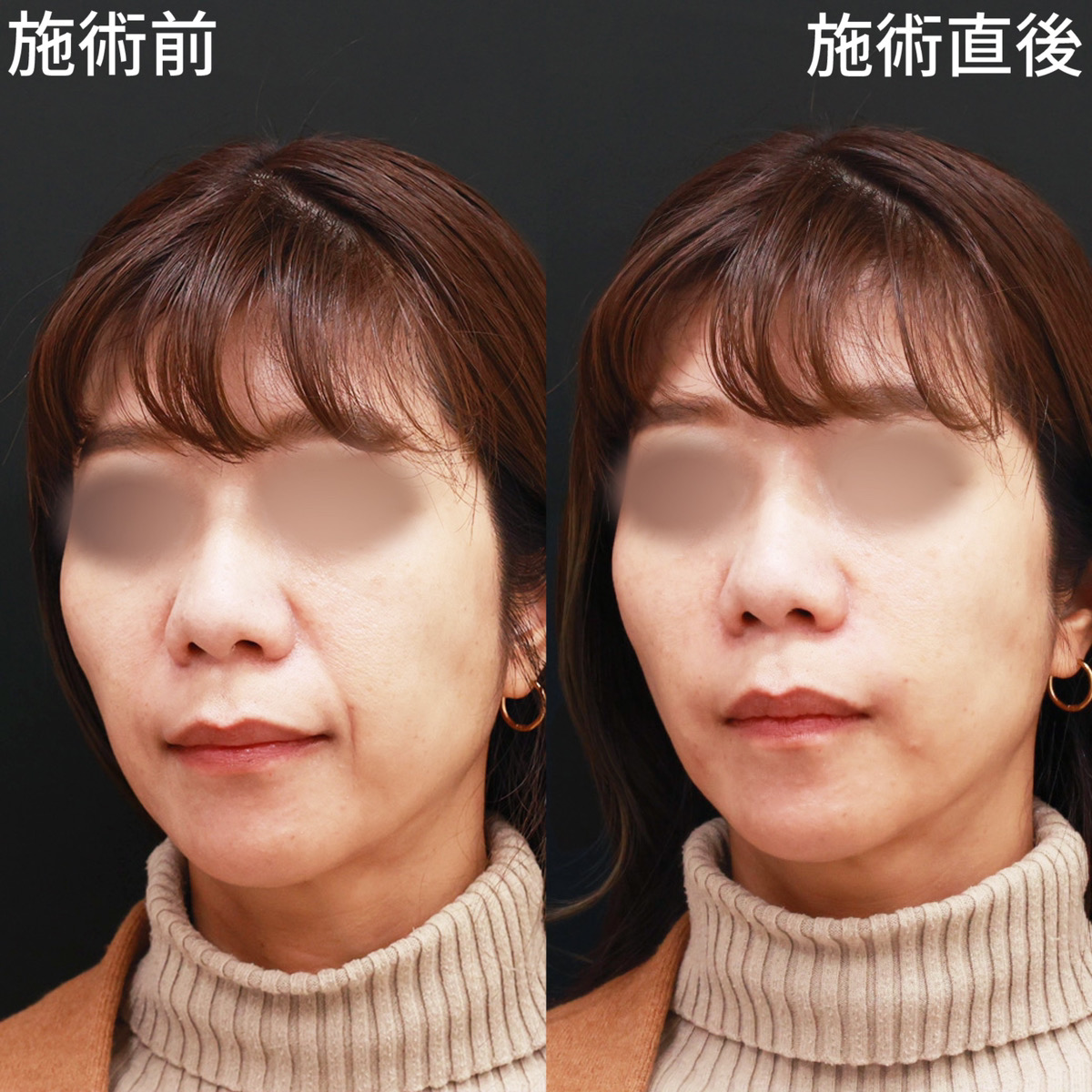 ほうれい線のヒアルロン酸注射の症例写真 施術前後