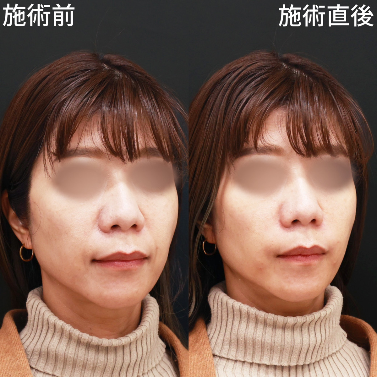 ほうれい線のヒアルロン酸注射の症例写真 施術前後