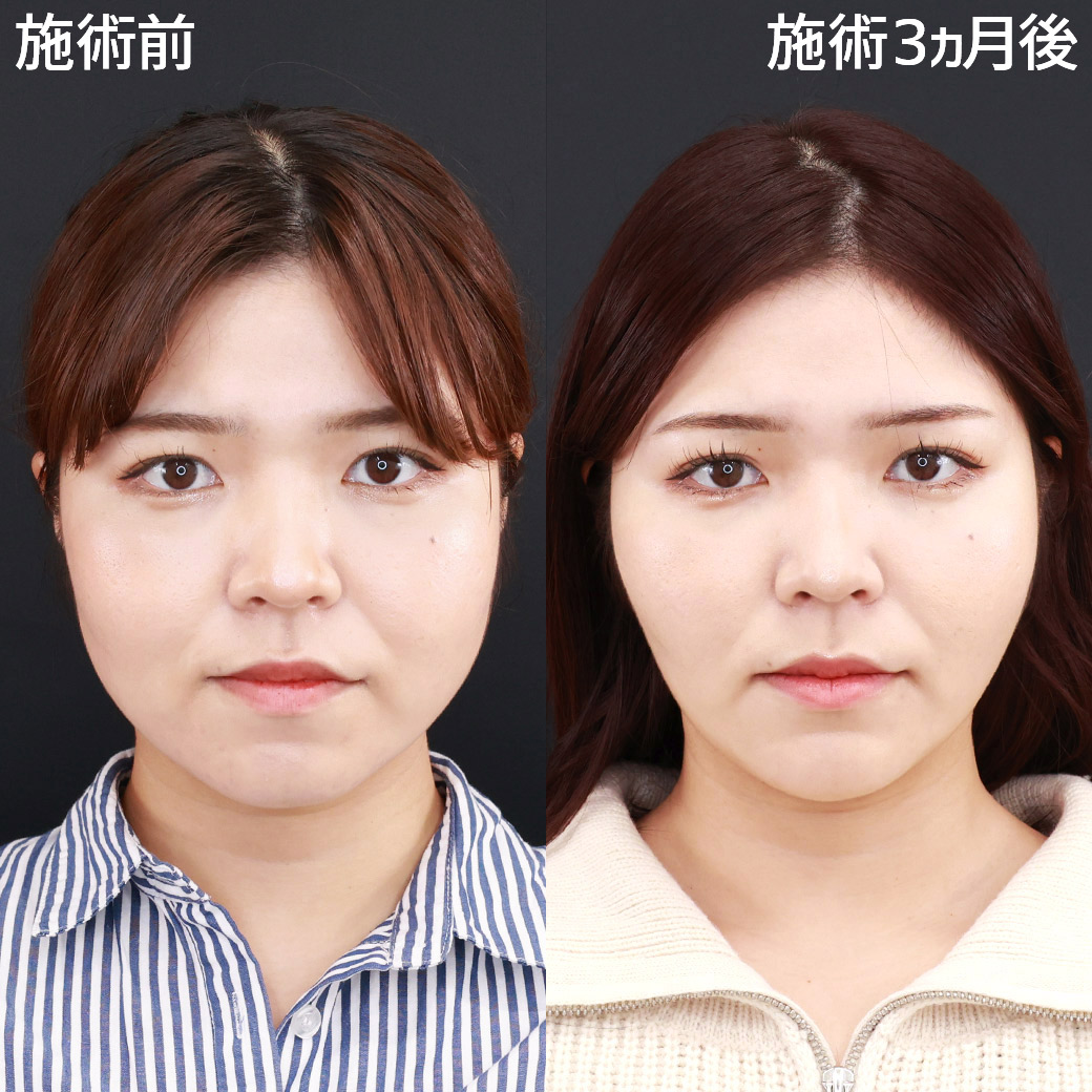 小顔整形｜パーフェクトフェイスライン/エラボトックス注射/顎のヒアルロン酸注射の症例写真 施術前後 