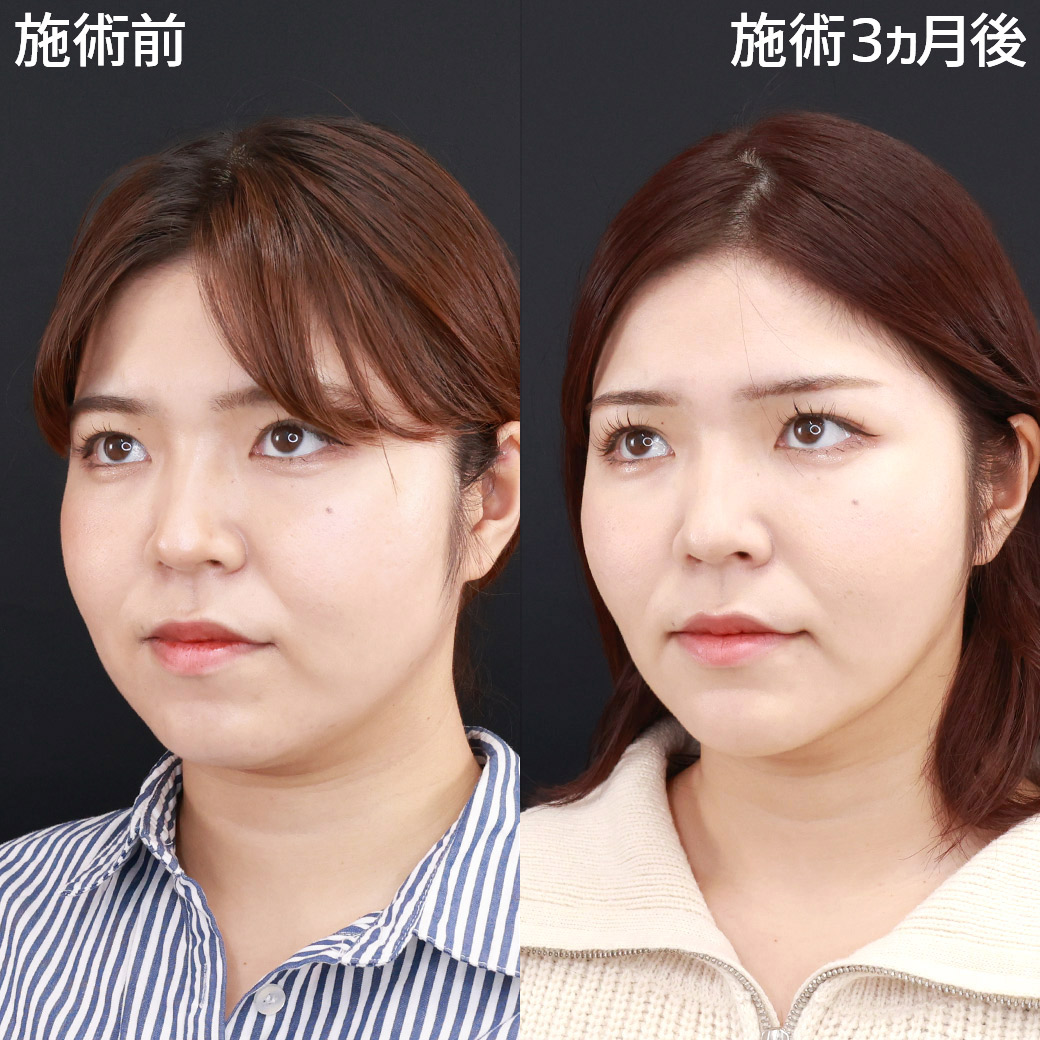 小顔整形｜パーフェクトフェイスライン/エラボトックス注射/顎のヒアルロン酸注射の症例写真 施術前後 