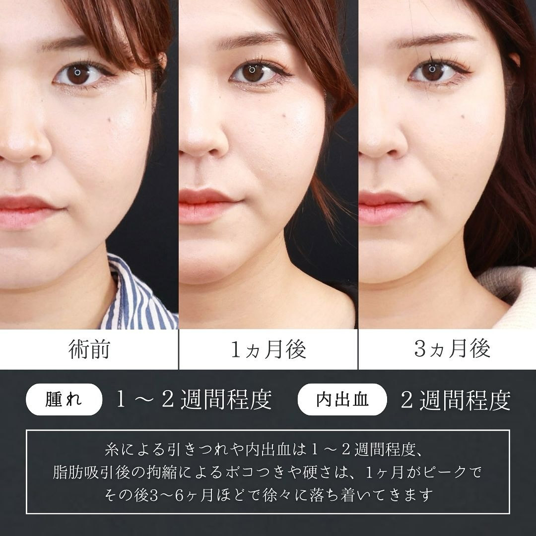 小顔整形｜パーフェクトフェイスライン/エラボトックス注射/顎のヒアルロン酸注射の症例写真 施術前後 