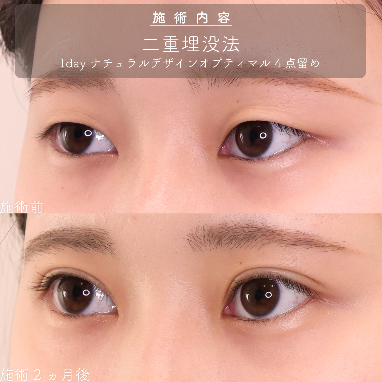 二重埋没法の症例写真 施術前後