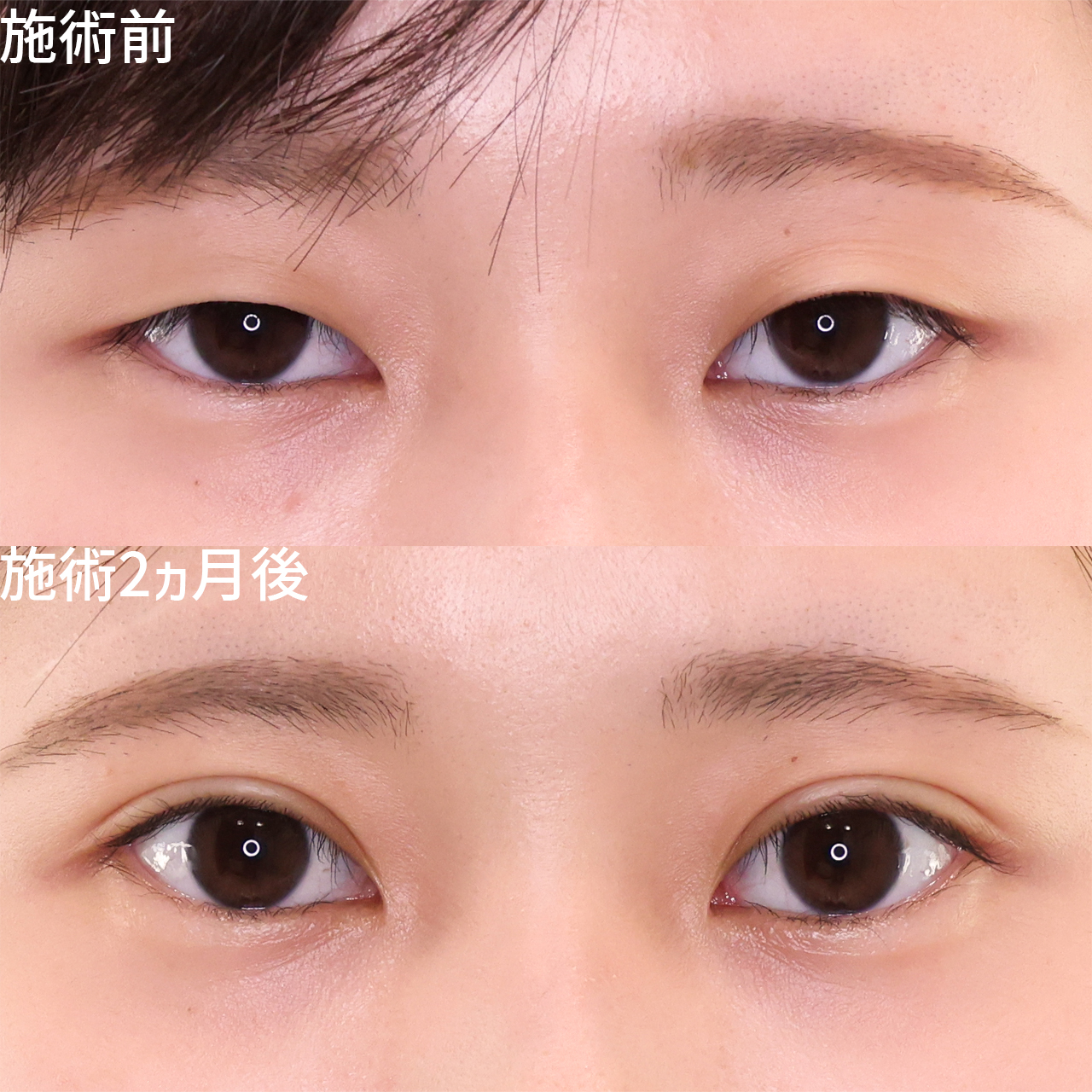 二重埋没法の症例写真 施術前後