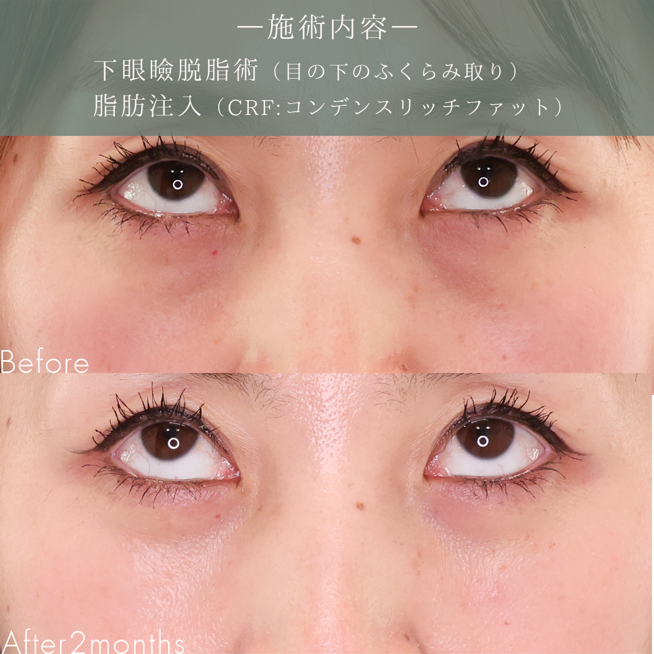 下眼瞼脱脂術（目の下のたるみ取り・目の下の脂肪ふくらみ取り）/顔の脂肪注入(コンデンスリッチフェイス)の症例写真 施術前後 