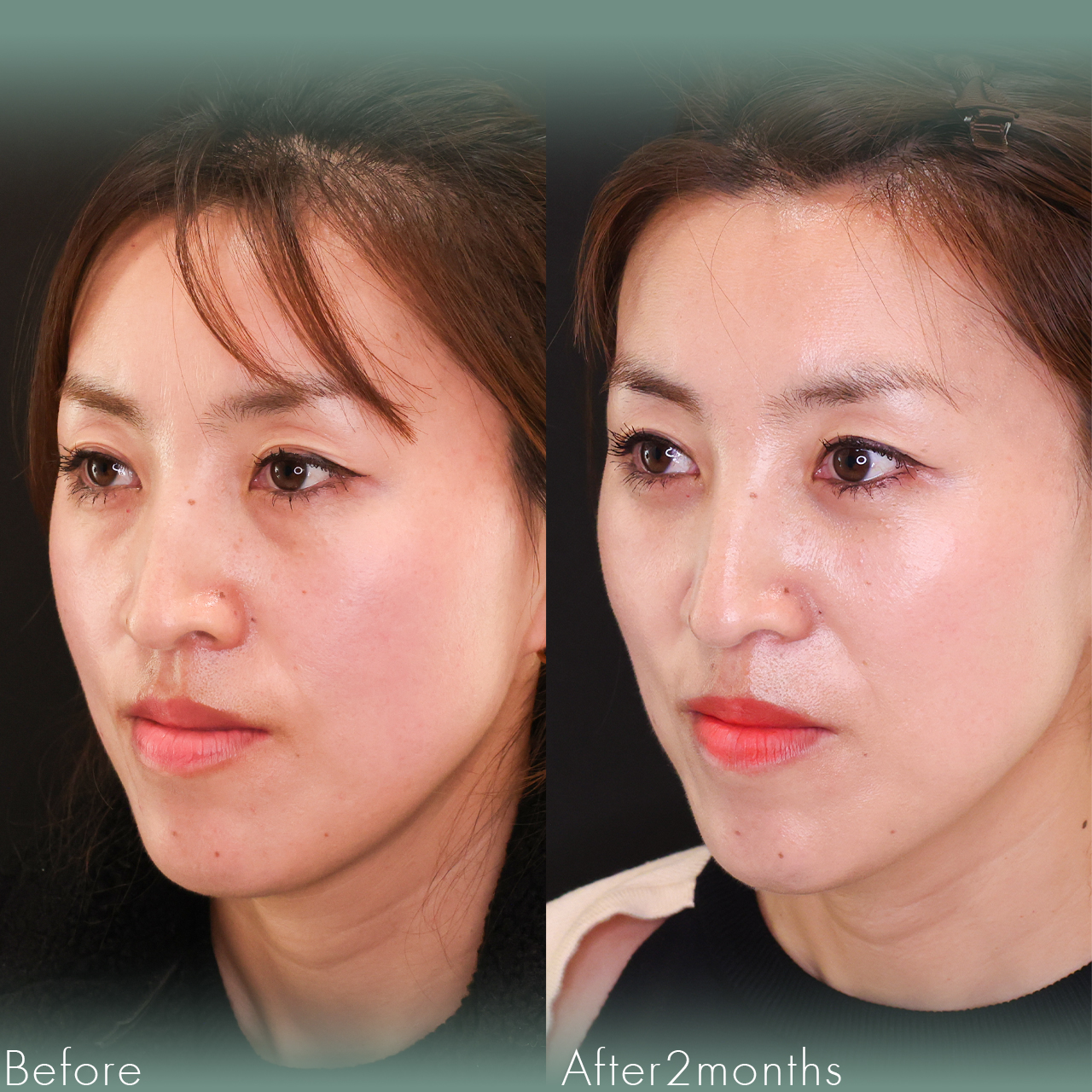 下眼瞼脱脂術（目の下のたるみ取り・目の下の脂肪ふくらみ取り）/顔の脂肪注入(コンデンスリッチフェイス)の症例写真 施術前後 