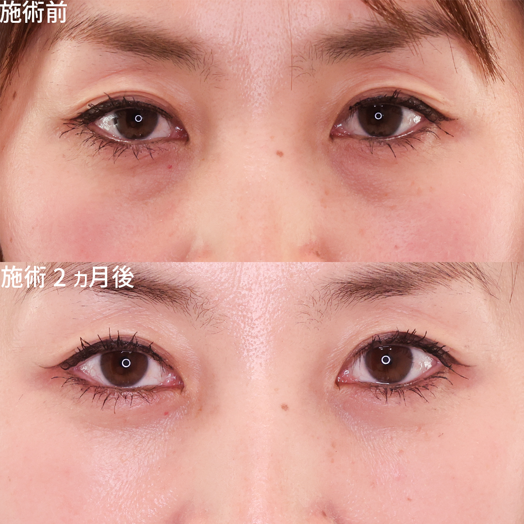 下眼瞼脱脂術（目の下のたるみ取り・目の下の脂肪ふくらみ取り）/顔の脂肪注入(コンデンスリッチフェイス)の症例写真 施術前後 