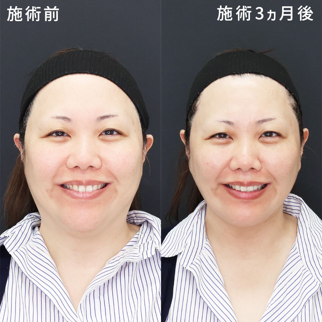笑った時の二重顎も解消《40代の脂肪吸引症例》