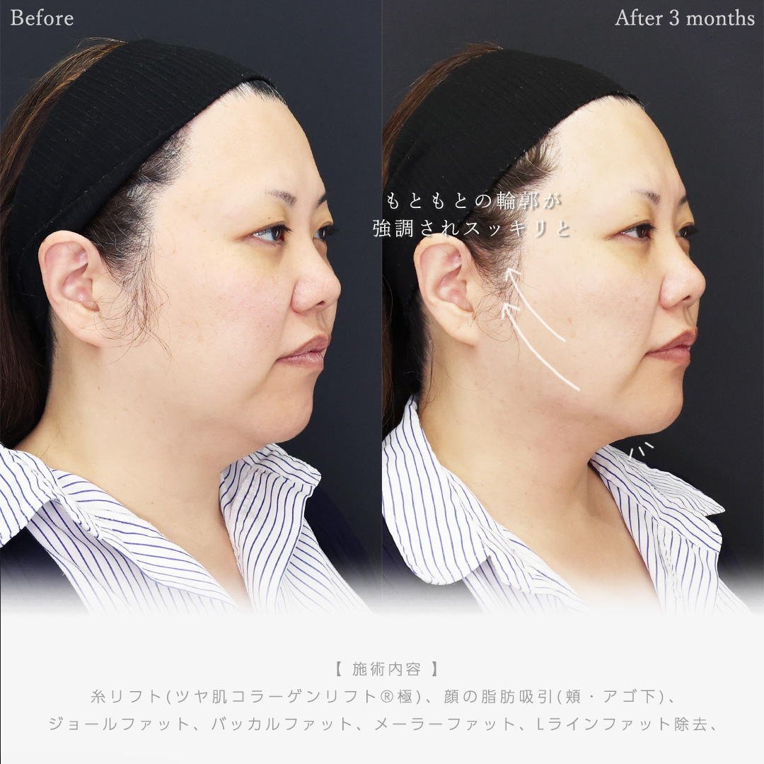 バッカルファット除去/体の脂肪吸引/ジョールファット除去の症例写真 施術前後 