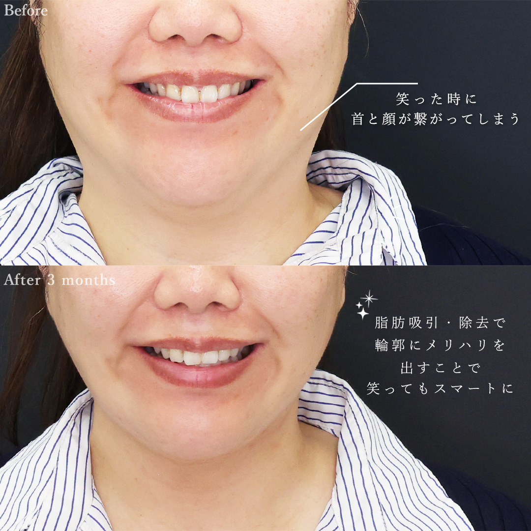バッカルファット除去/体の脂肪吸引/ジョールファット除去の症例写真 施術前後 