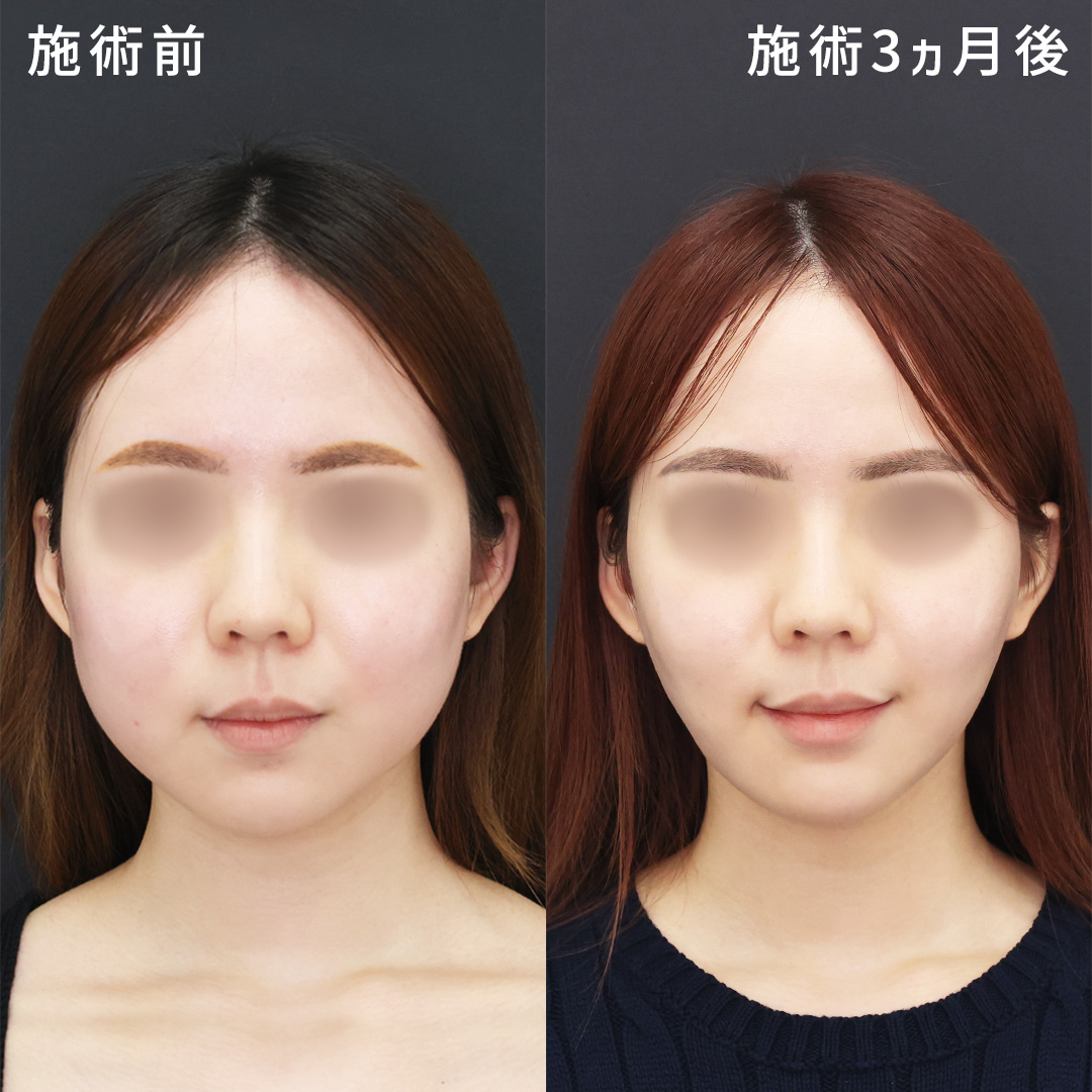 もたつきゼロの卵型フェイスラインに|形成外科専門医の小顔術