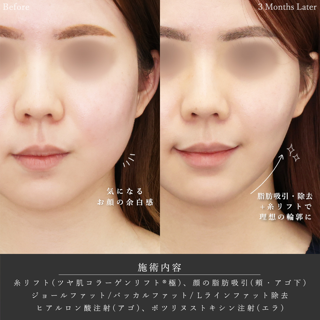 バッカルファット除去/顔の脂肪吸引/TAC式 ツヤ肌コラーゲンリフト®の症例写真 施術前後 