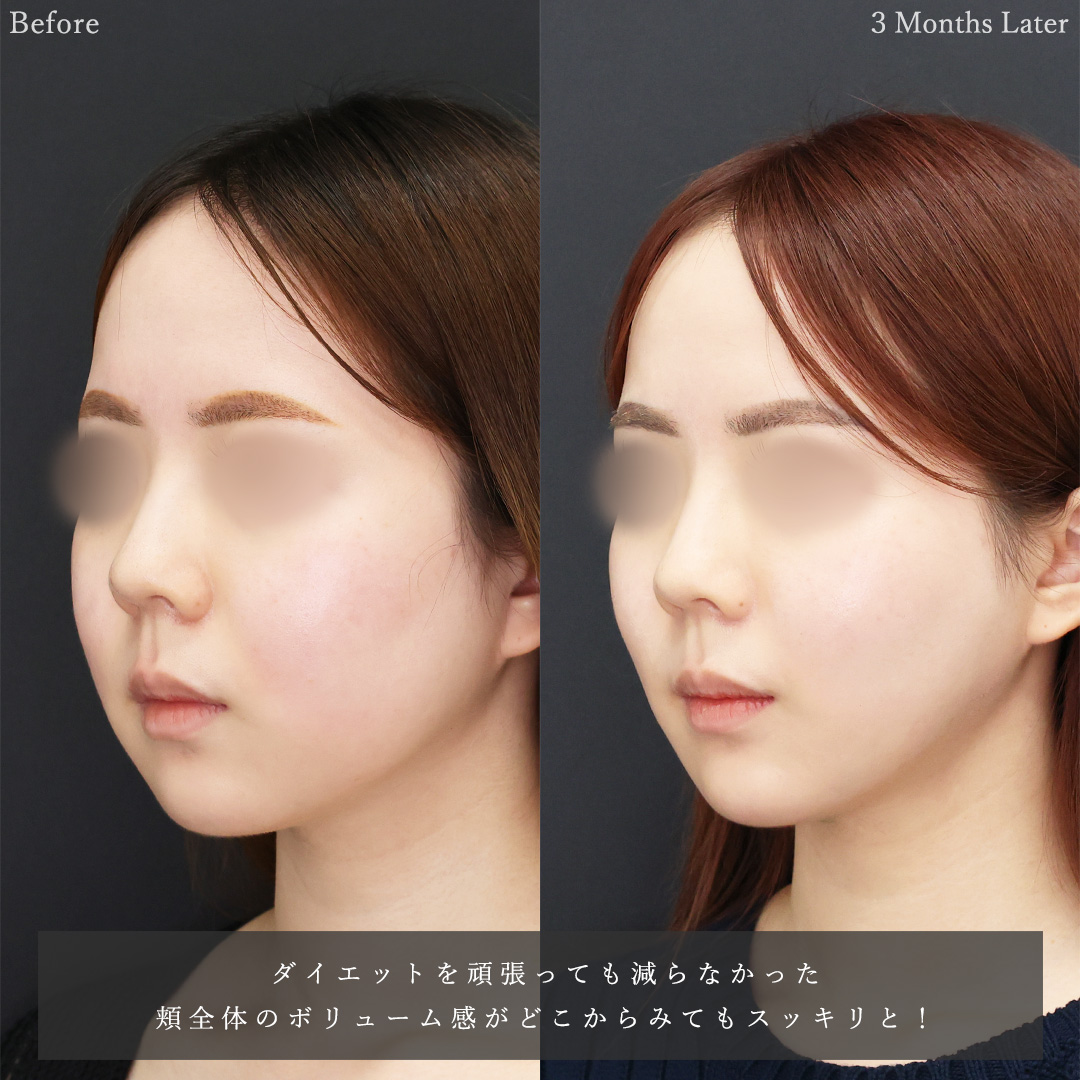 バッカルファット除去/顔の脂肪吸引/TAC式 ツヤ肌コラーゲンリフト®の症例写真 施術前後 