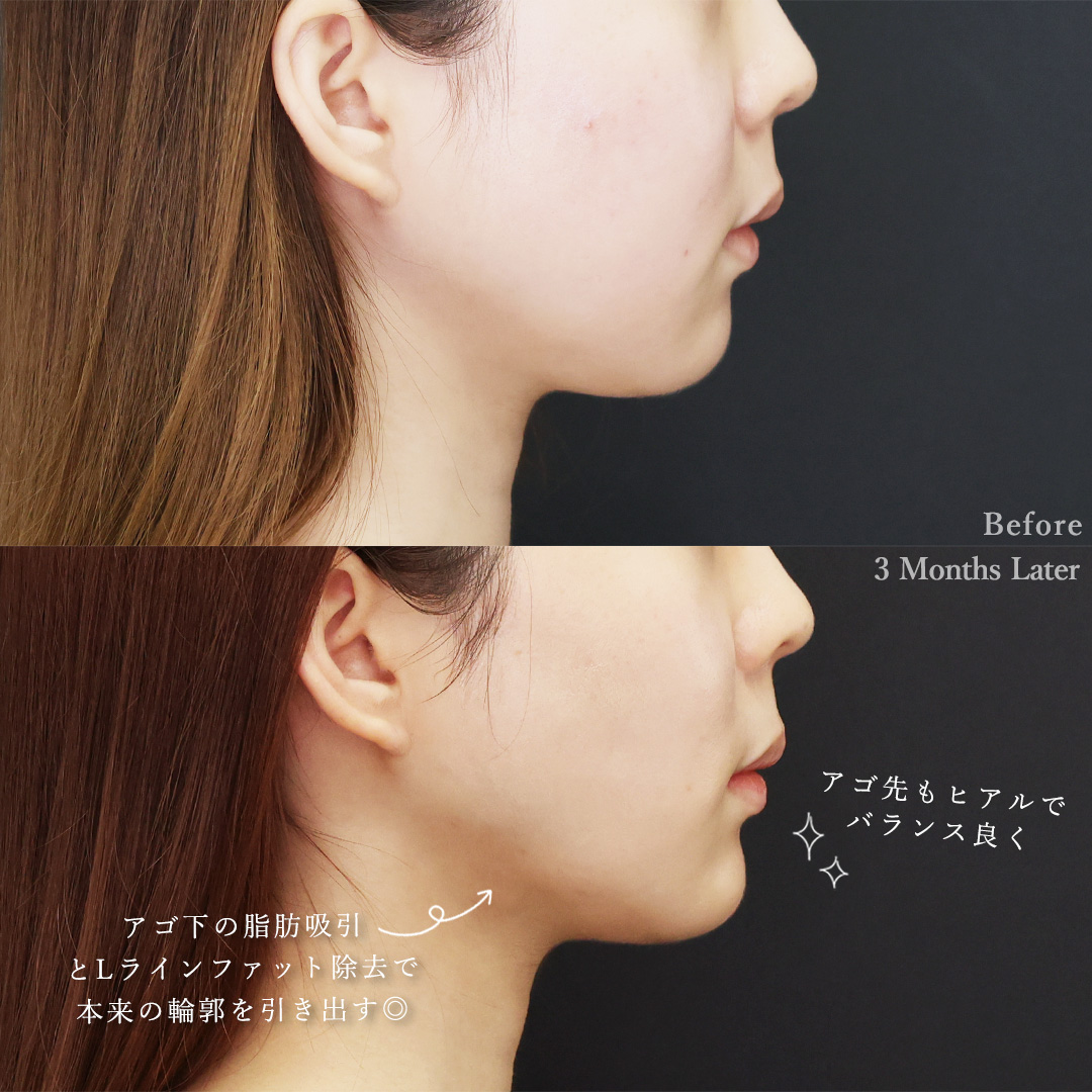 バッカルファット除去/顔の脂肪吸引/TAC式 ツヤ肌コラーゲンリフト®の症例写真 施術前後 