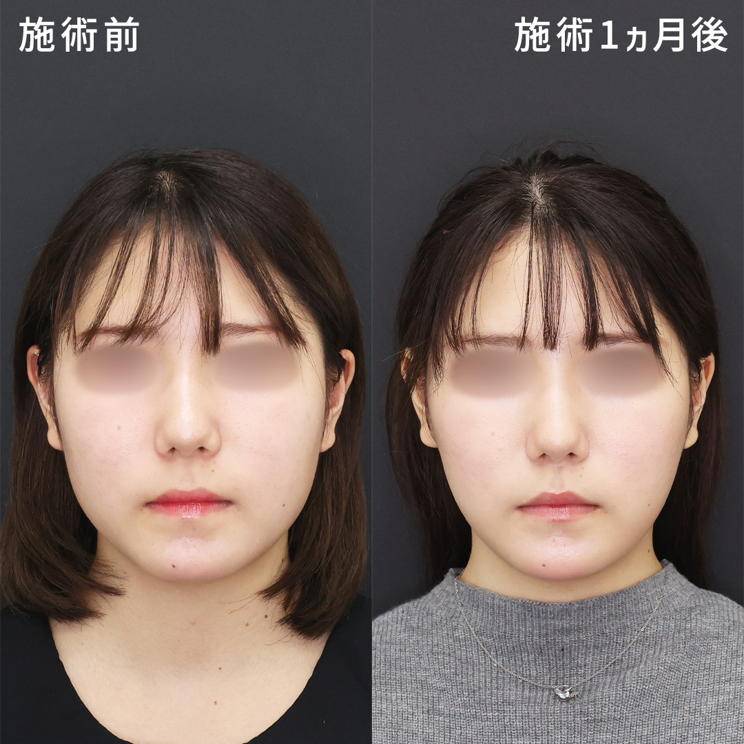 《脂肪吸引×糸リフト》頬の丸さを改善し、加工アプリなしでも小顔に