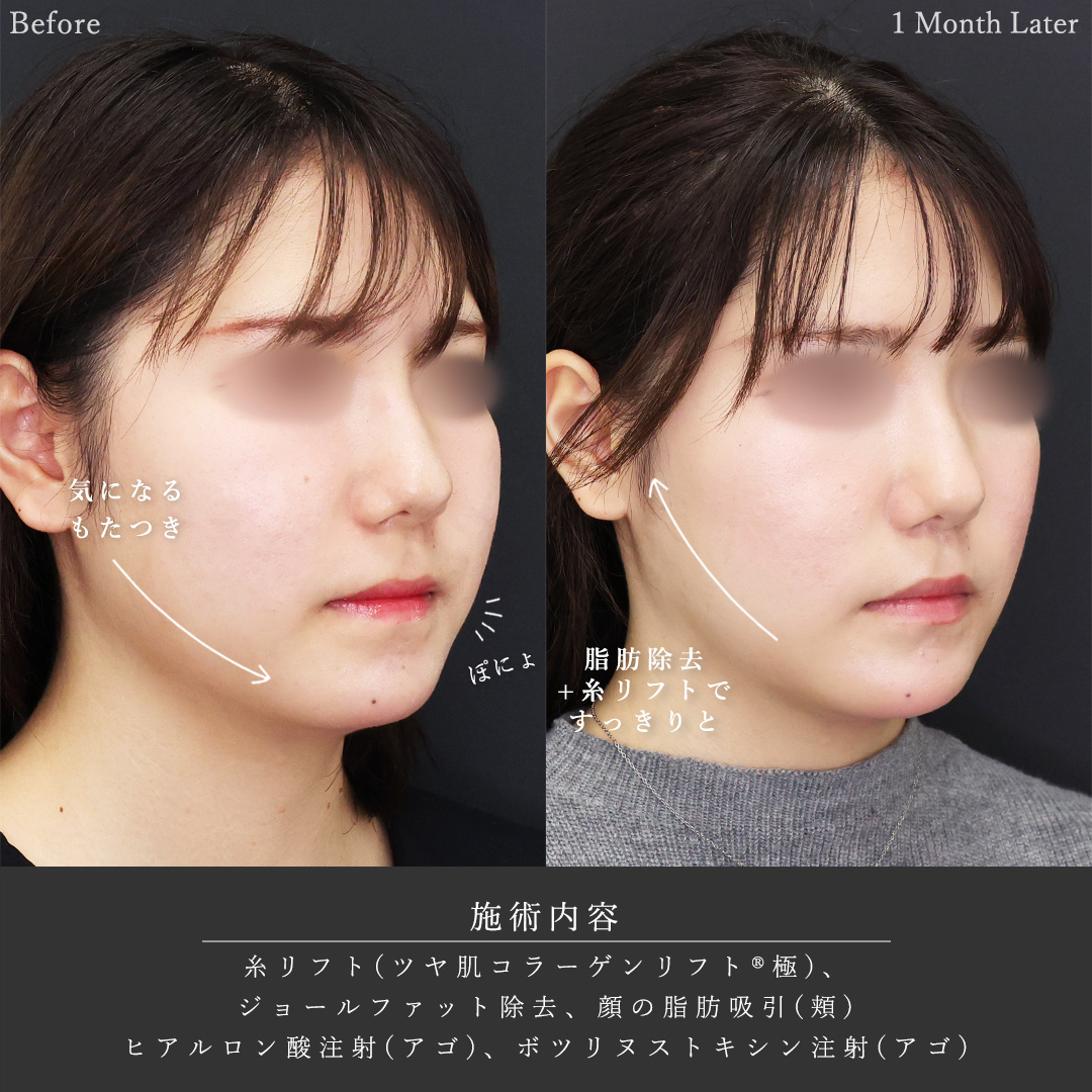 顔の脂肪吸引/ジョールファット除去/顎のヒアルロン酸注射の症例写真 施術前後 