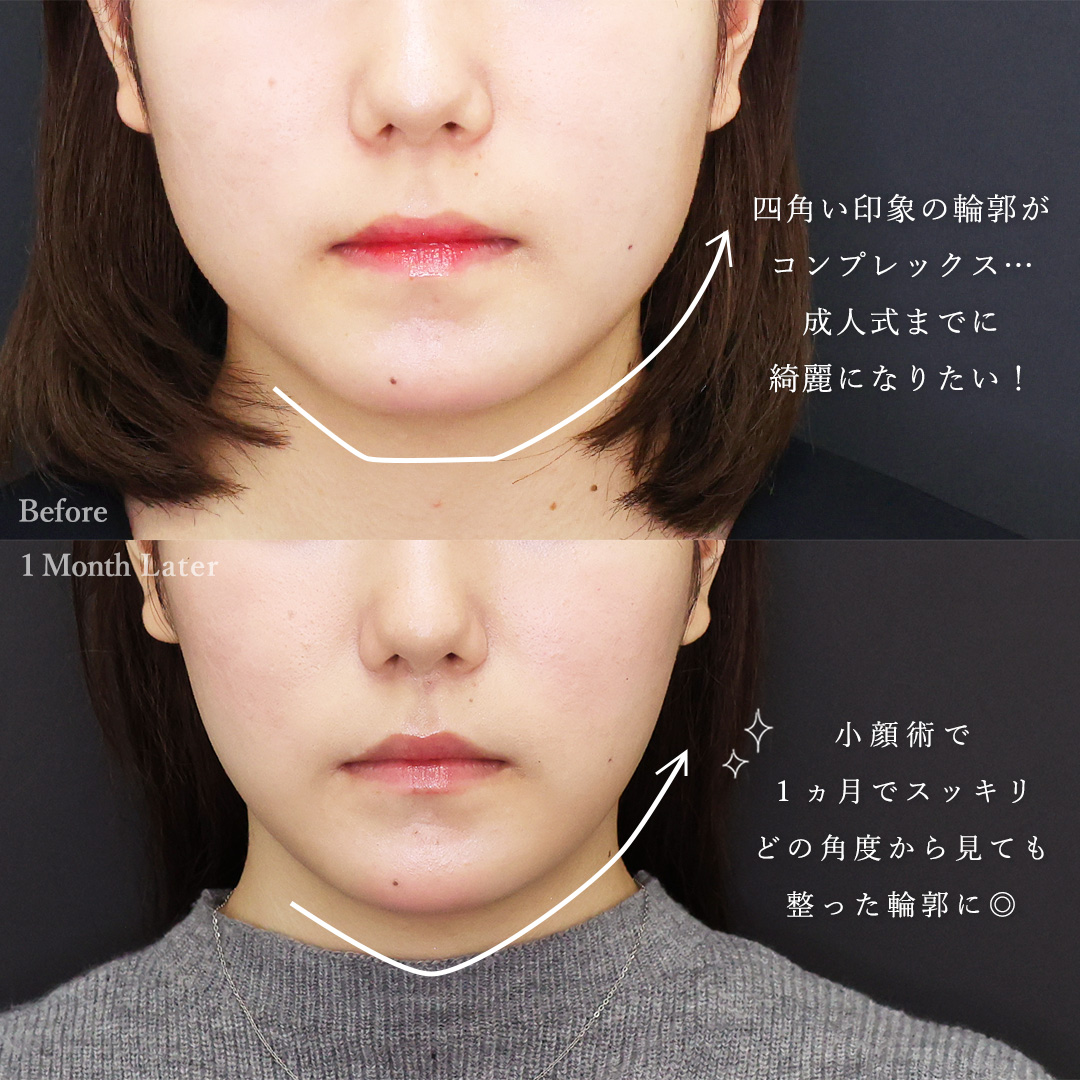 顔の脂肪吸引/ジョールファット除去/顎のヒアルロン酸注射の症例写真 施術前後 