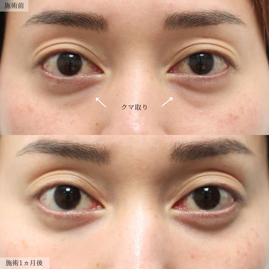 下眼瞼脱脂術（目の下のたるみ取り・目の下の脂肪ふくらみ取り）の症例写真 施術前後 