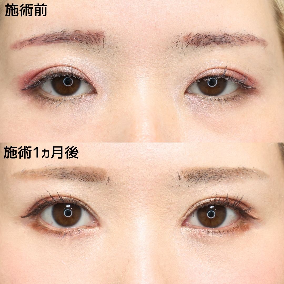 二重埋没法/目頭切開術の症例写真 施術前後