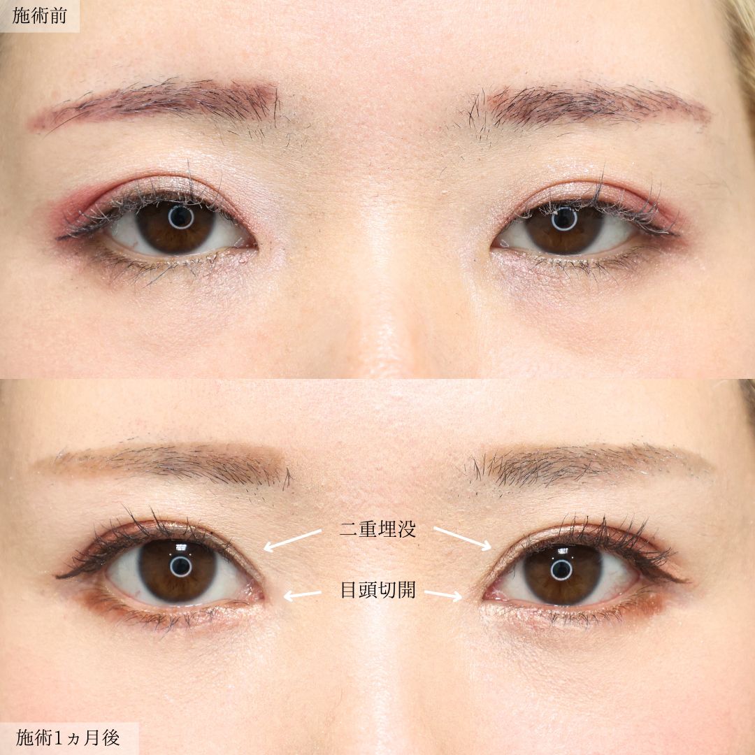 二重埋没法/目頭切開術の症例写真 施術前後