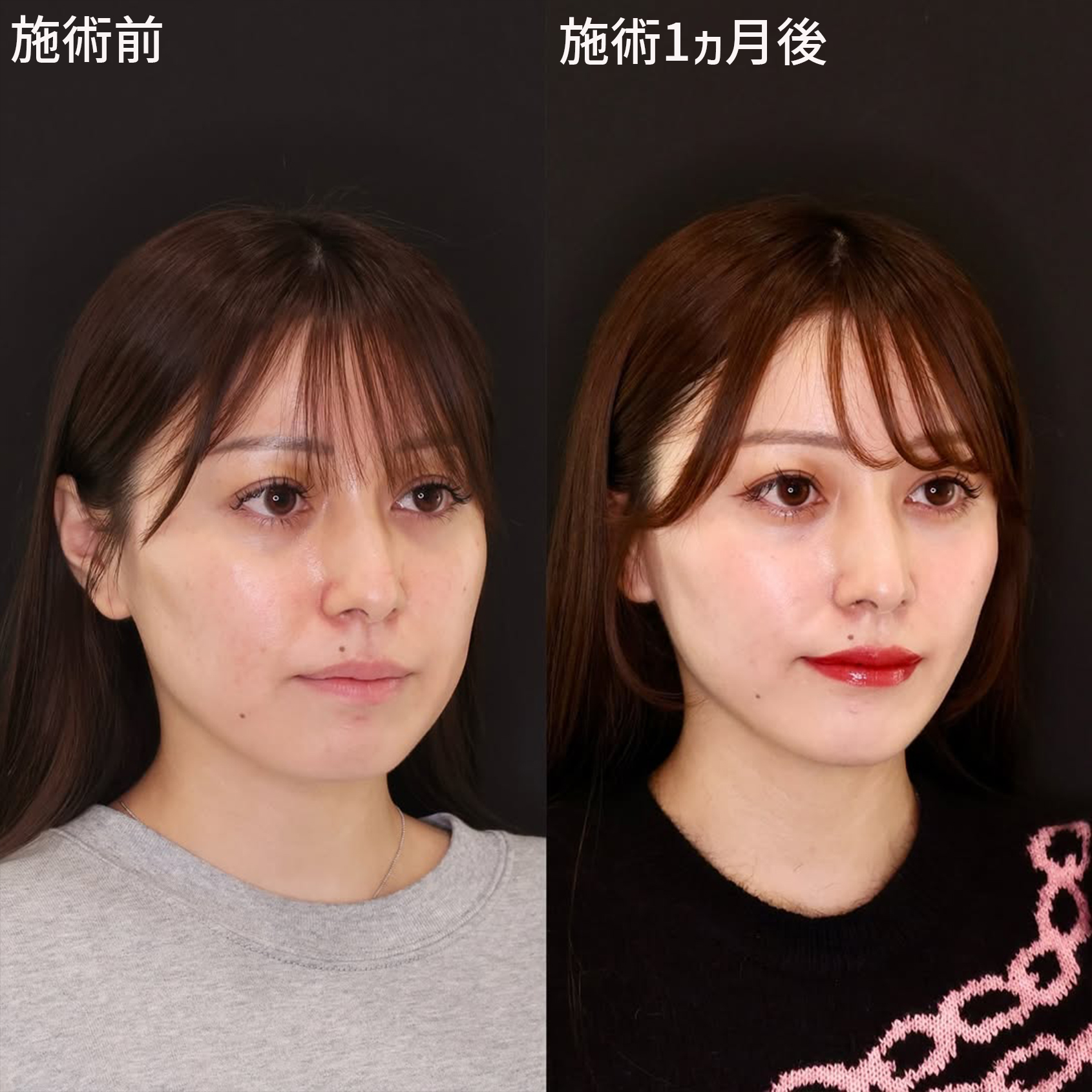 TAC式 ツヤ肌コラーゲンリフト®/ジョールファット除去/顔の脂肪吸引の症例写真 施術前後