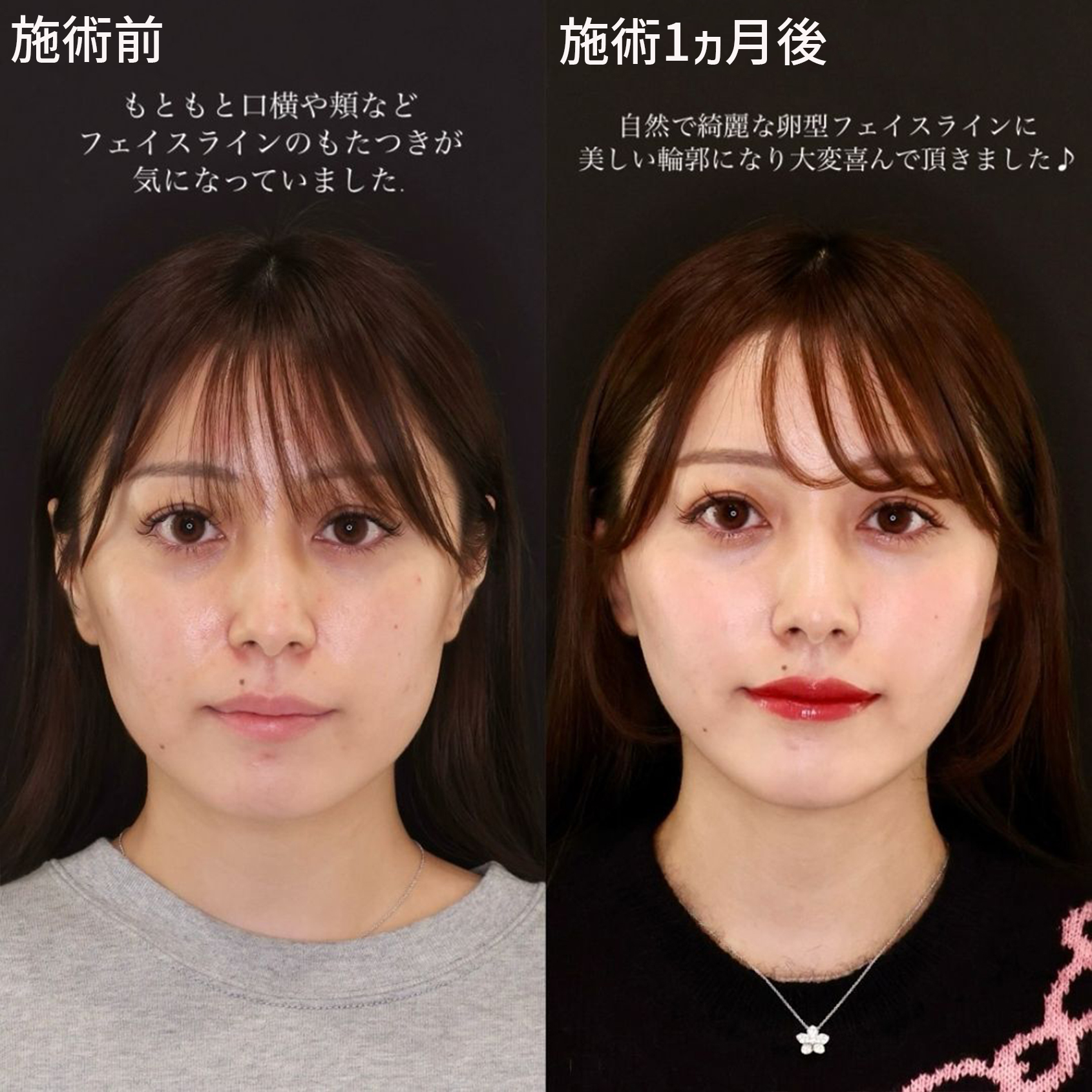 TAC式 ツヤ肌コラーゲンリフト®/ジョールファット除去/顔の脂肪吸引の症例写真 施術前後