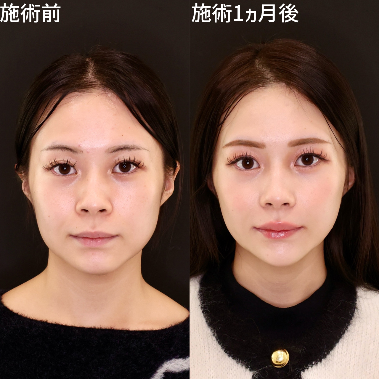 顔の脂肪吸引/ジョールファット除去/Lラインファット除去（エラ下脂肪除去）の症例写真 施術前後 