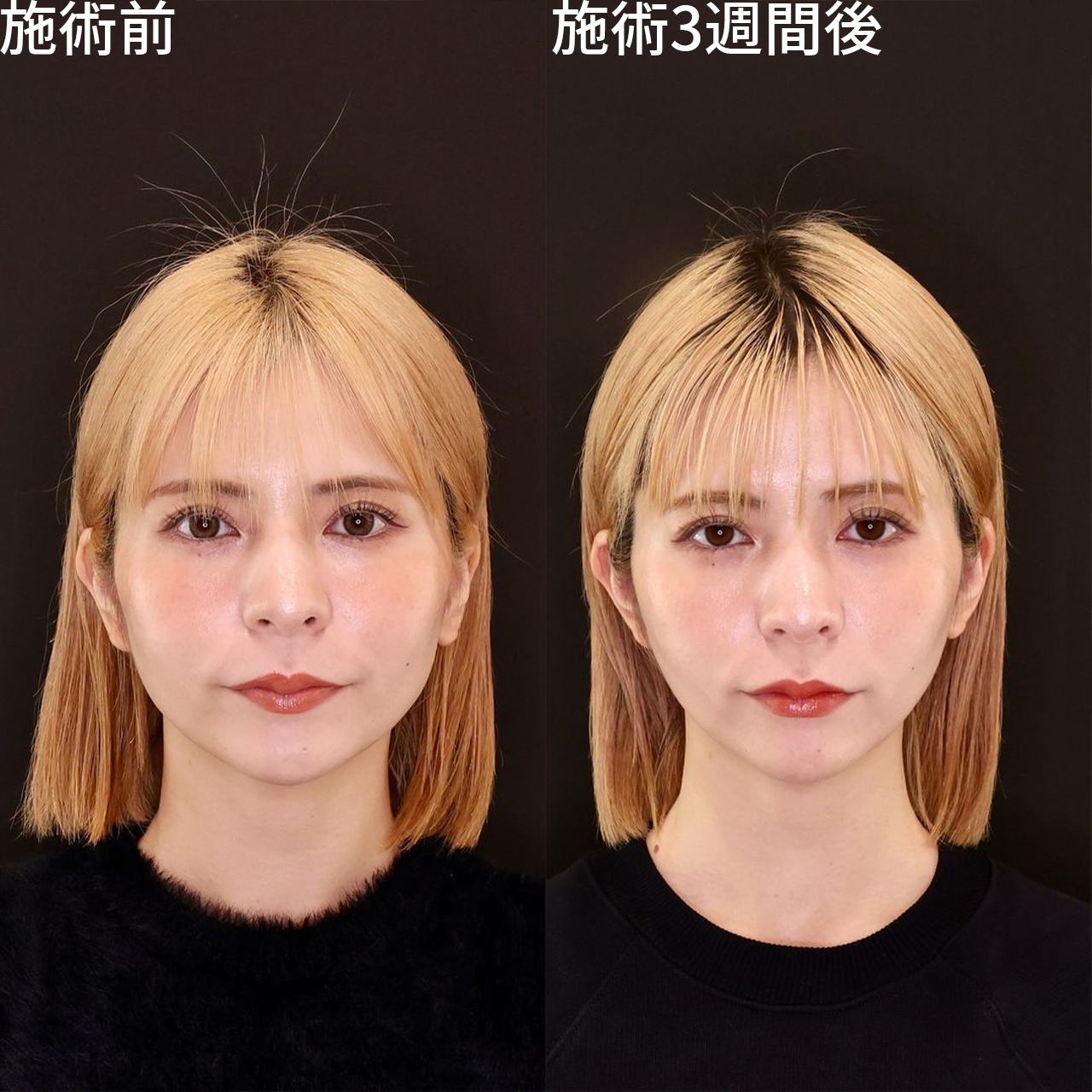 全国から指名多数！人気モデルもDr.もりもりの糸リフトで美しいフェイスラインに