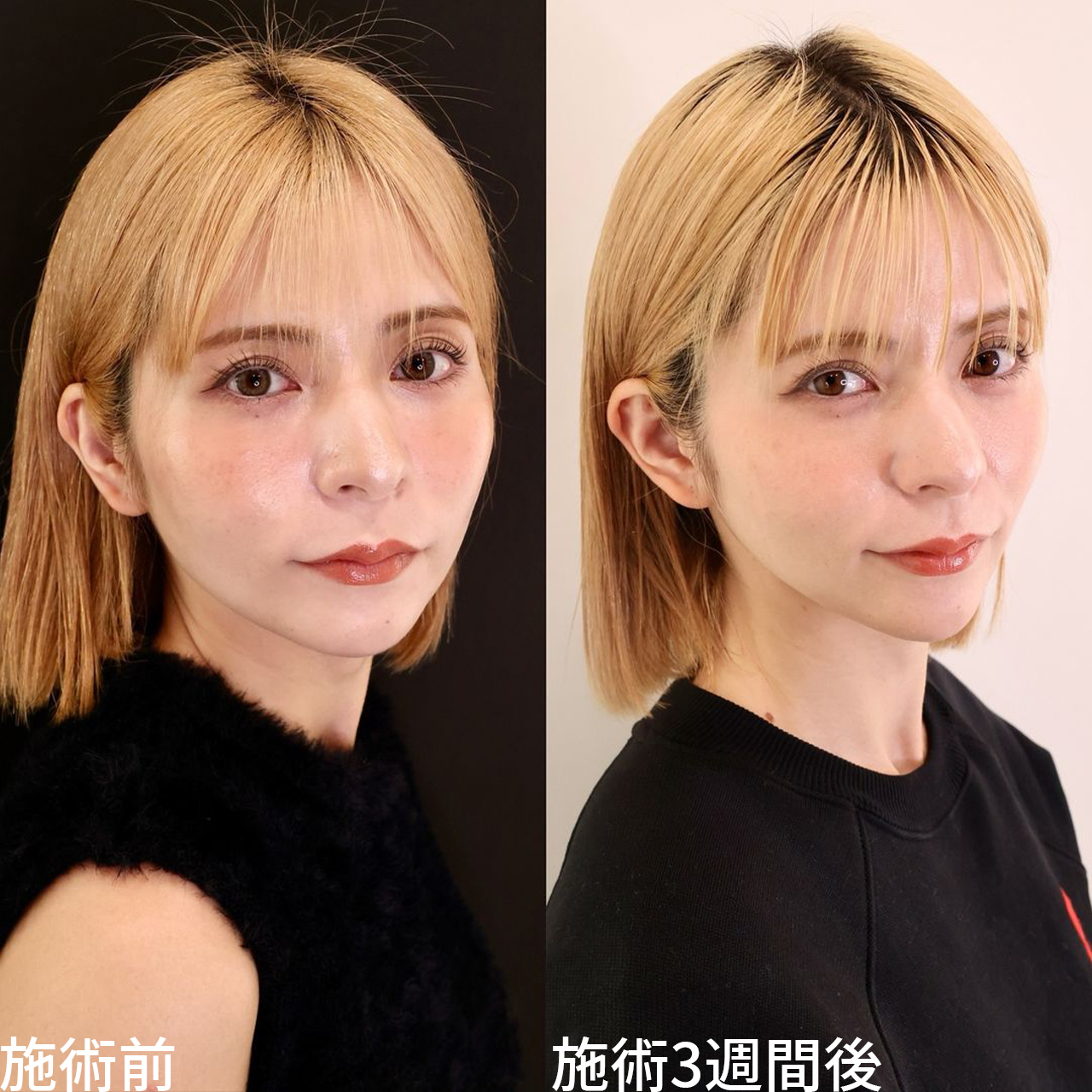 TAC式 ツヤ肌コラーゲンリフト®/エラボトックス注射の症例写真 施術前後 