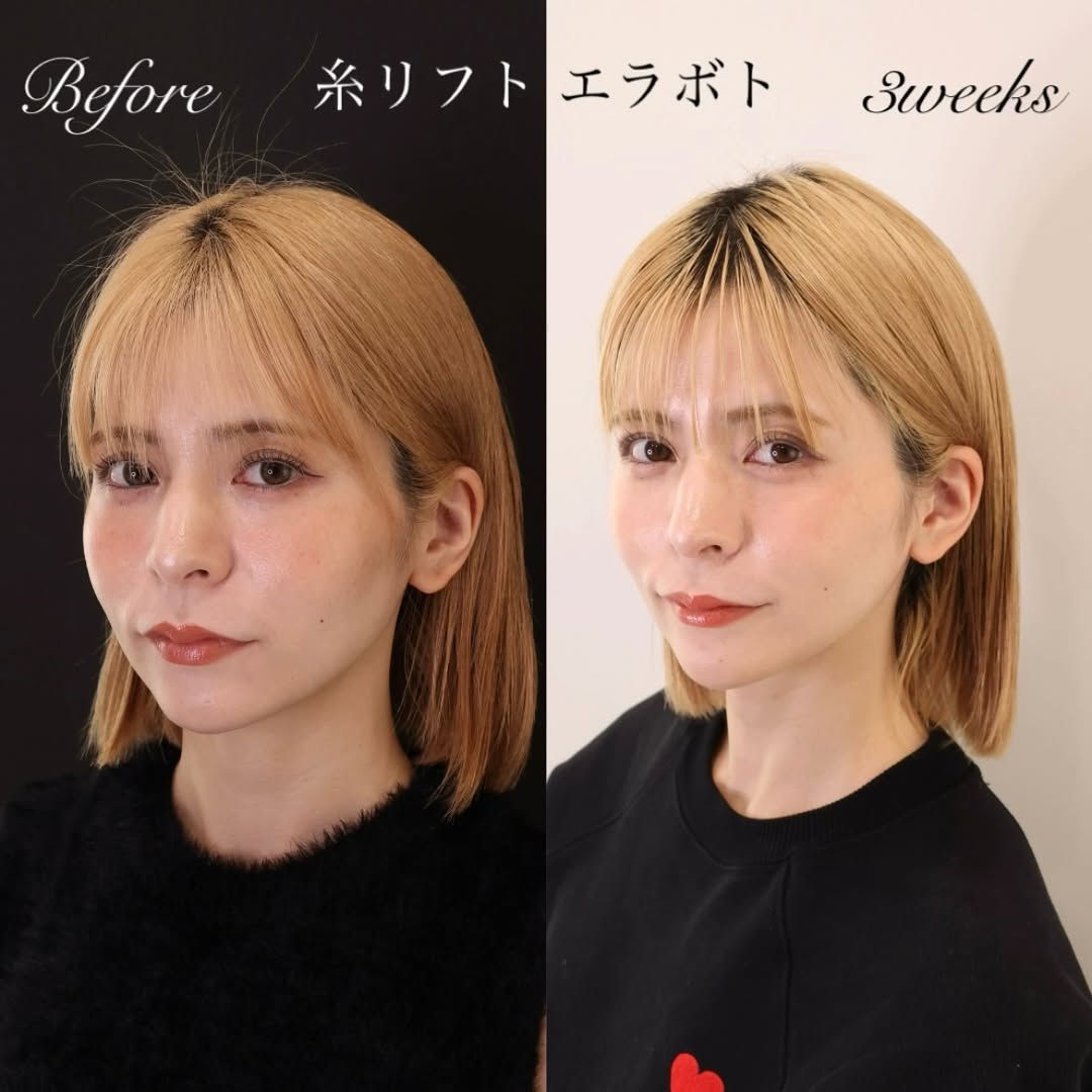 TAC式 ツヤ肌コラーゲンリフト®/エラボトックス注射の症例写真 施術前後 