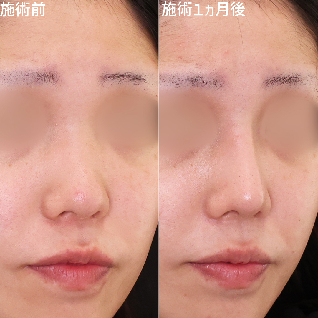 【鼻整形】プロテーゼと鼻尖形成で垢抜け鼻に