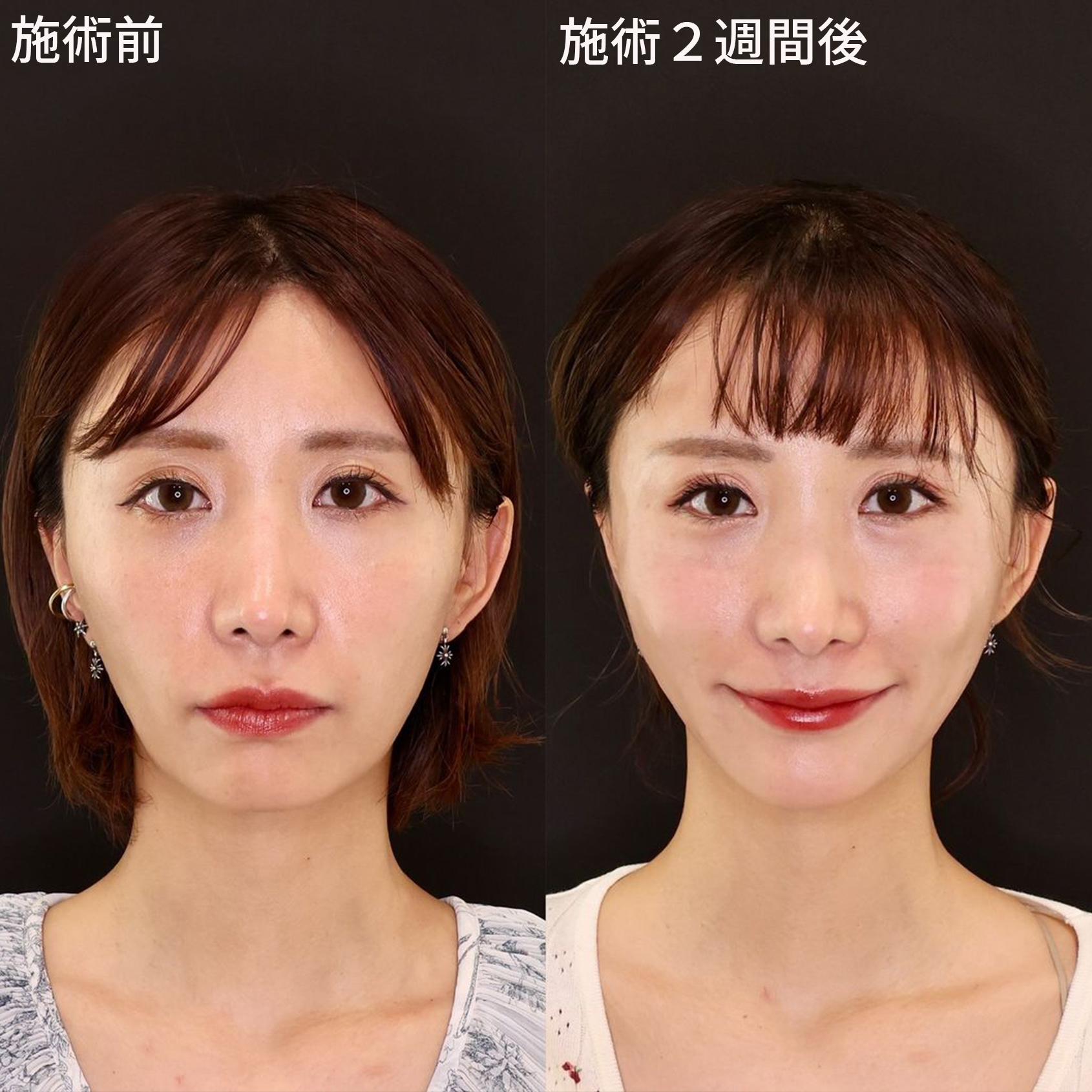 見た目年齢マイナス5歳の若返り♡元SDN48光上せあらさん小顔整形