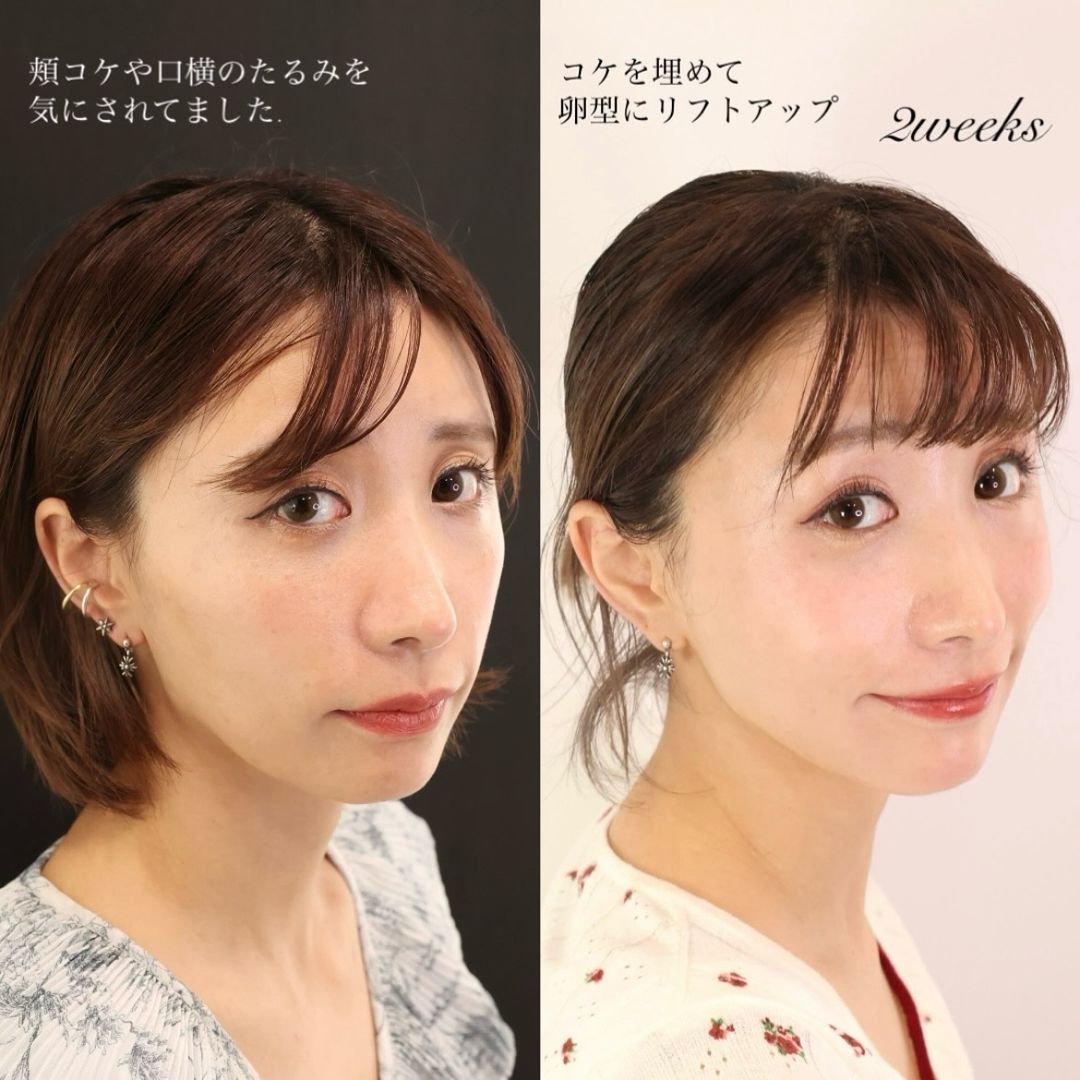 TAC式 ツヤ肌コラーゲンリフト®/ヒアルロン酸注射:その他の症例写真 施術前後