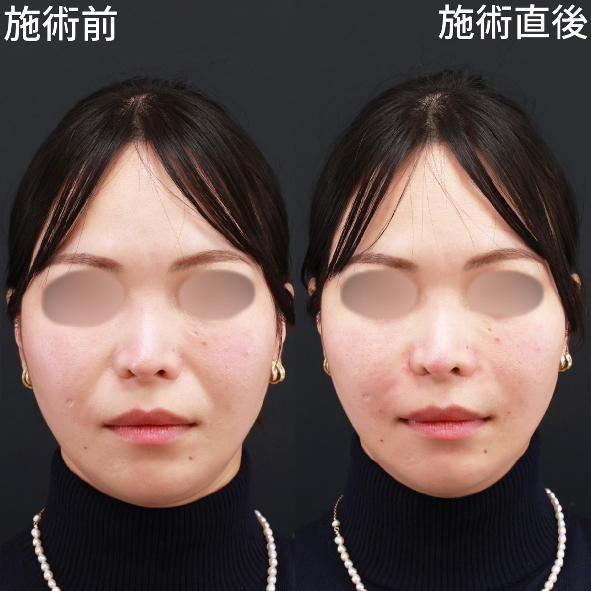 【法令線＆鼻翼基部ヒアルロン酸】注射だけで老け見えを解消！