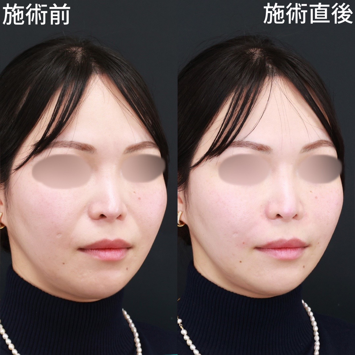 ほうれい線のヒアルロン酸注射/ヒアルロン酸注射：その他の症例写真 施術前後 